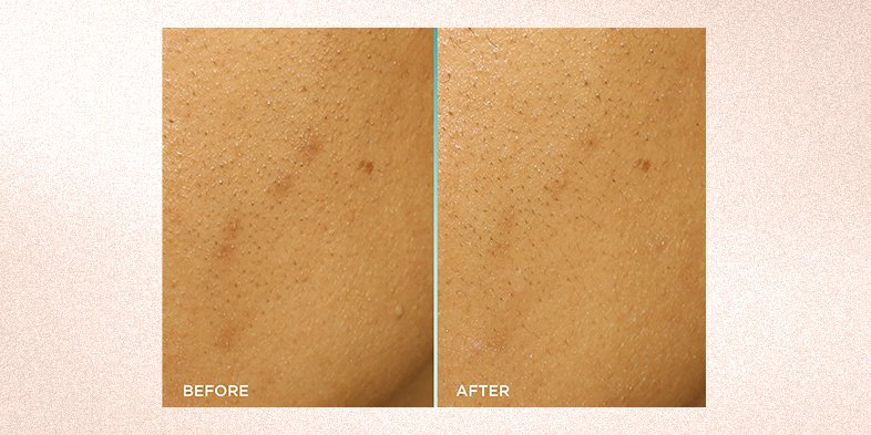 Before and after comparison smoother skin
